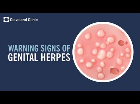 herpes in penus|Herpes Symptoms in Men: Signs and Symptoms of。